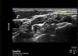 Image result for Superior Trunk Block