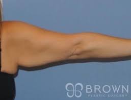 Elastic Arm Shaper Slimming Compression Sleeves - Temu