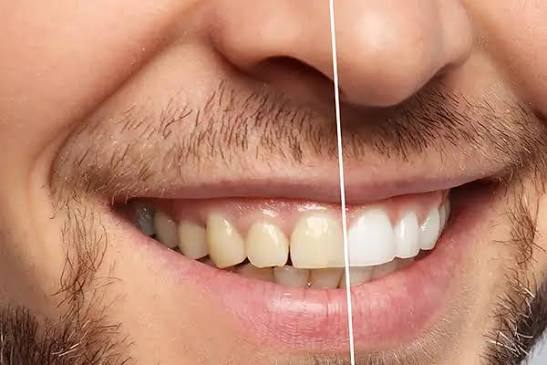 Teeth Whitening Falls Church & Herndon, VA