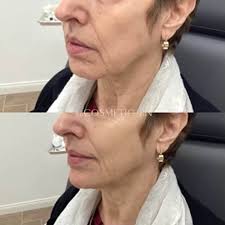 Patty Dalton — Botox, Filler, Fat Removal │ Aluma Medical Aesthetics
