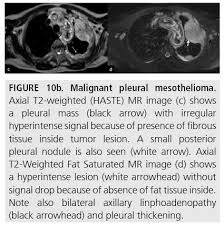 Malignant pleural mesothelioma (mpm) is a rare disease for which there is. Diagnostic Imaging And Workup Of Malignant Pleural Mesothelioma
