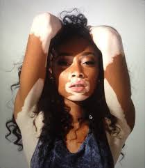 Black And White Skin Condition Model From Moon 2 Moon Beauty Chantelle Brown Young Chantelle Brown