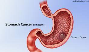 In fact, stomach cancer signs may be heartburn, indigestion, changes in appetite, nausea and vomiting. Early Signs Symptoms Of Stomach Cancer Diagnosis Of Stomach Cancer