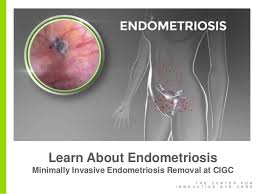 90.000 stichwörter und wendungen sowie 120.000 wichtigste übersetzungen. Dr Paul Mackoul Md Learn About Endometriosis And Minimally Invasive