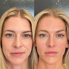 Victoria C, RN (@trubeauty_rninjectorvictoria) • Instagram photos and videos