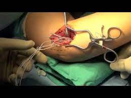 Tommy john surgery, or ucl reconstruction, replaces the ligament inside the elbow with a tendon from elsewhere in the body. Elbow Ulnar Collateral Ligament Tommy John Surgery Dr Randy S Schwartzberg Youtube