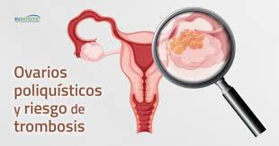 Encuentra los mejores especialistas en trombosis en españa y resuelve tus dudas preguntando a los expertos. Sindrome De Ovarios Poliquisticos Y Riesgo De Trombosis