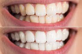 We did not find results for: White Stains On Your Teeth Stonebrook Family Dental In Aurora Co 14555 E Arapahoe Rd Unit D Aurora Co 80016