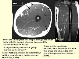 In the knee mri mastery courses, we give you everything you need in order to evaluate this joint. Axial Coronal These Are T1 Weighted Mri Images Through The Lower Thigh Note The Coronal Reference Image And The Corresponding Axial Image These Are The Ppt Video Online Download