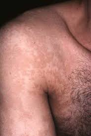 La mycose vaginale ou mycose vulvaire (candidose vaginale) est causé par un microscopique champignon appelé candida albicans. Mycose Causes Symptomes Traitement Teleconsultation Dermatologue