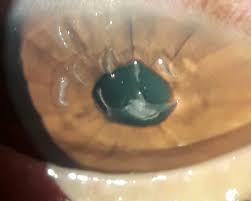 We did not find results for: Keratitis Wikipedia