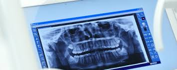 Eine wurzelbehandlung ist von fall zu fall unterschiedlich kompliziert. Wurzelbehandlung Am Zahn Wissenswertes Endodontie 360 Zahn