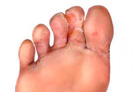 Athlete S Foot Tinea Pedis Perform Podiatry