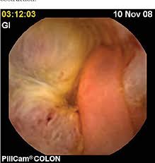 Colorectal cancers detected after colonoscopy frequently result from missed lesions a significant number of patients undergoing a screening colonoscopy that did not detect cancer actually have a malignant lesion or adenoma that could progress in a short interval. Colon Cancer Detection By Rendezvous Colonoscopy Successful Removal Of Stuck Colon Capsule By Conventional Colonoscopy Semantic Scholar