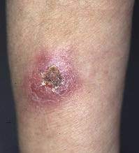Tb skin test the tb skin test, also known as the mantoux tuberculin skin test, is the most common way doctors diagnose tuberculosis. Atypical Cutaneous Tuberculosis In A Patient With Rheumatoid Arthritis Treated With Infliximab Html Acta Dermato Venereologica