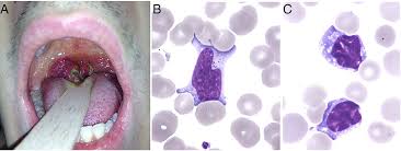 If you suspect you have mononucleosis, see your family doctor. Necrotic Sore Throat Tender Lymphadenopathies Hepatitis And Activated Lymphocytes In Circulating Blood As A Clinical Presentation Of Severe Infectious Mononucleosis Bmj Case Reports