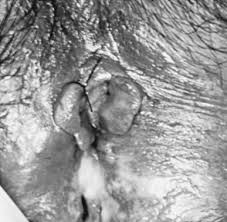 Image result for chancroid