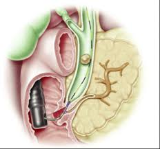 Biliary strictures are one of the causes of primary intrahepatic bile duct stones. Gallstones Cholelilthiasis Cedars Sinai Medical Towers Los Angeles Ca La Digestive Health And Wellness