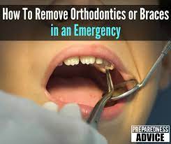 Dec 06, 2014 · the braces should help straighten out your front teeth. How To Remove Orthodontics Or Braces In An Emergency Preparedness Advice