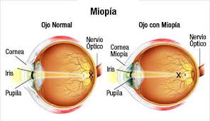 Resultado de imagen para miopia
