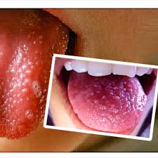 Llagas En La Lengua Por Que Llagas En La Lengua Bolitas En La Lengua Lengua