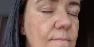 Image result for Melasma