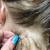 Scalp Ringworm Early Stages