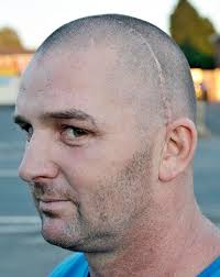 Stuart Bentley's X-ray shows the NINE metal plates inserted in his head