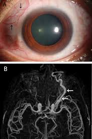 Bloodshot or red eyes occur when small blood vessels that are present on the surface of the eye become enlarged and congested with blood. A Red Eye After Head Injury The Bmj