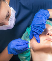 Thread Lift Dubai at Nova Clinic