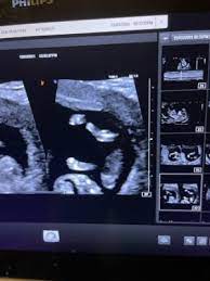 Can T See One Of My Baby S Legs In 12 Week Ultrasound September 2021 Birth Club Babycenter Australia