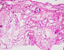 Epidemiology it occurs as an opportunistic infection in immunocompromised patients. February 3 2020 Week 2 School Of Medicine Pathology Uab