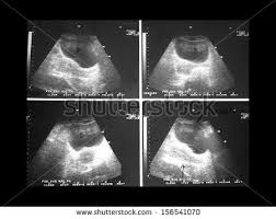 Bladder Ultrasound Stock Photos Images Pictures Ultrasound Stock Photos Bladder