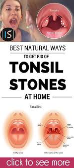 Black And White Spots On Tonsils Pin On Tonsil Stones