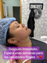 lipopapada #bichectomia #medicinaestetica