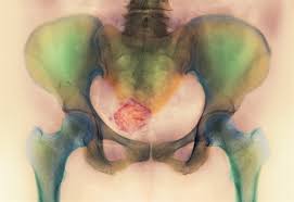 Chtěla bych zkusit přírodní léčbu, jsou na myom nějaké bylinky. Proti Cystam A Myomum Pomohou Bylinky A Zdravy Zivotni Styl Idnes Cz