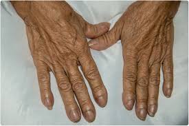 Many people with lung cancer don't have symptoms until the disease is in its later stages. Lung Cancer And Nail Clubbing