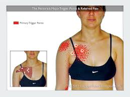 The clavicular head originates from the front of your collar bone (medial clavicle), then continues down your upper arm bone (humerus) where it attaches. Trigger Points In The Pectoralis Major Muscle Aberdeen Chiropractic