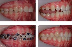 And what are they for? bite turbos primary purpose is to. The Use Of Functional Appliances In Contemporary Orthodontic Practice British Dental Journal