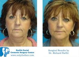 Parfitt Facial Cosmetic Surgery Center, 2261 Deming Way, Middleton, WI  53562, US