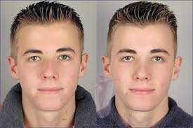Nose surgery before and after male. Rhinoplasty Before After Photo Gallery Paramus Nj Parker Center For Plastic Surgery