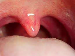 A canker sore looks like an ulcer, usually with a depression in the center. 9 Swollen Uvula Uvulitis Causes Why Is My Uvula Swollen