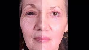 Seen above, this beautiful patient underwent a Phenol, Croton oil peel..  the image shows the left side of face before phenol croton peel and two  months following phenol peel for reduction of facial ...