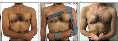 We did not find results for: Can An Acute High Grade Acromioclavicular Joint Separation Be Reduced And Stabilized Without Surgery A Surgeon S Experience Springerlink