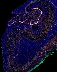 Check spelling or type a new query. Brain Cells Most Vulnerable To Alzheimer S Disease Identified By Scientists Uc San Francisco