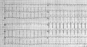 If you buy from a link, we may earn a commission. Ecg Ekg Examples And Quiz Oxford Medical Education