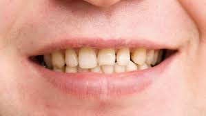 Det må vanligvis ikke behandles, men hvis det skulle gjøre vondt kan reseptfrie smertestillende og antiinflammatoriske medisiner hjelpe. Tanngnissing Nhi No