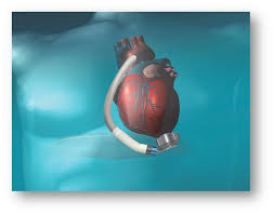 Baptist Health Medical Center Little Rock Implant S The State S First Heartmate Iii