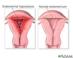 Theories on the pathogenesis of endometriosis. Disease Endometriosis