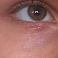 Was Ist Das Fur Ein Ausschlag Unter Dem Auge Haut Augen Blaeschen
